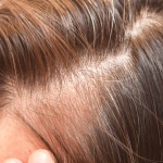 detalle de la pérdida de cabello debida a la alopecia areata.