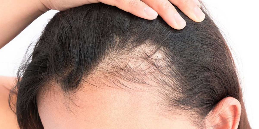 existen diferentes tipos de alopecia que causan la caída del cabello.