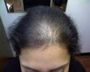 alopecia androgenetica 
