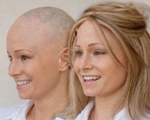 alopecia por quimioterapia
