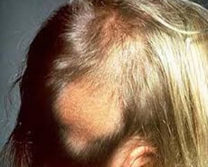 alopecia por quemaduras